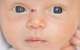 Пигментные пятна у детей — фото, причины и лечение Пигментные пятна у новорожденного